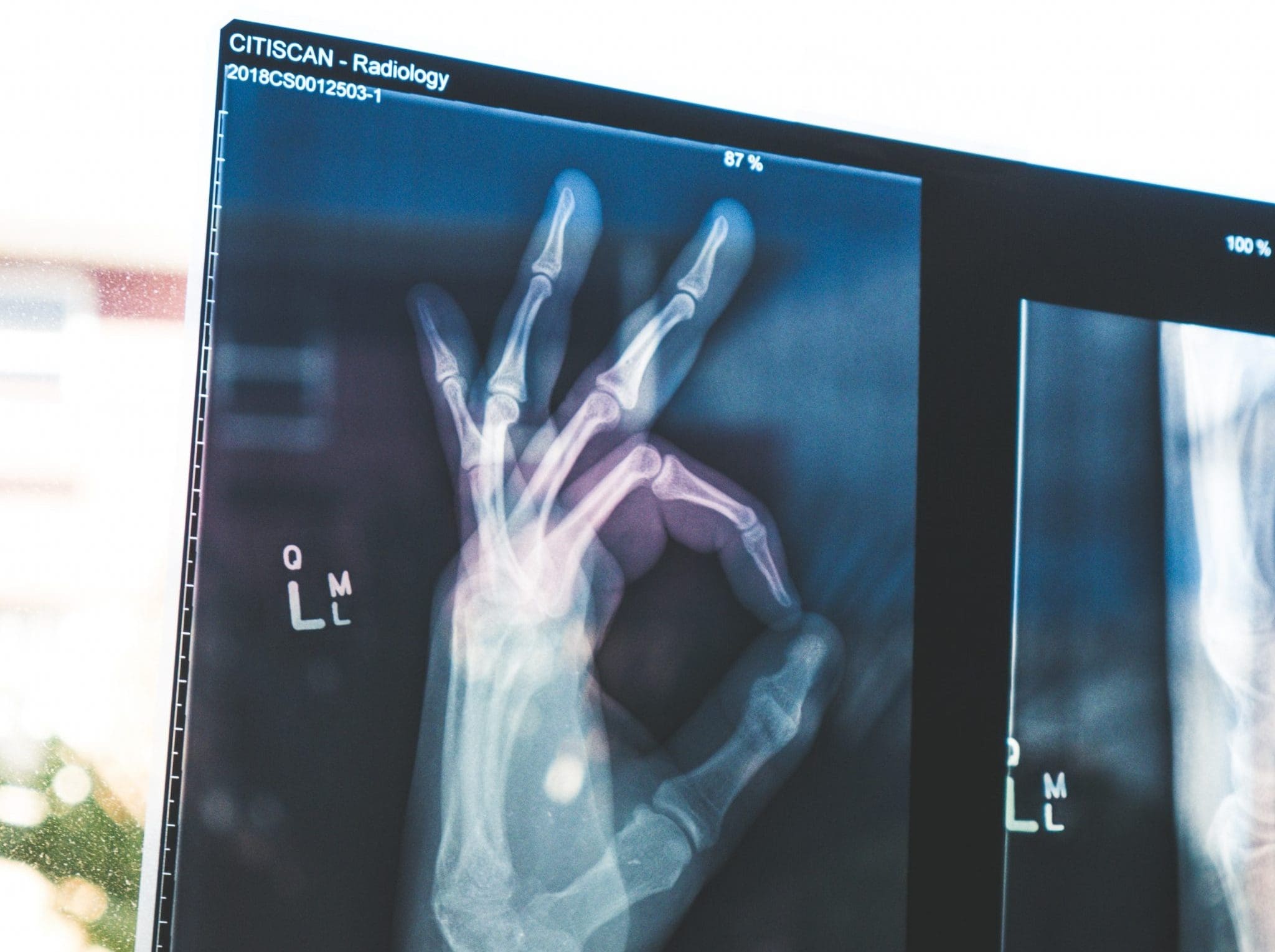 osteoporosis