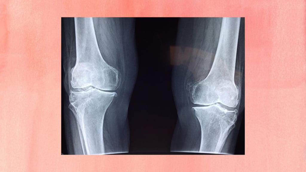 Bone Health